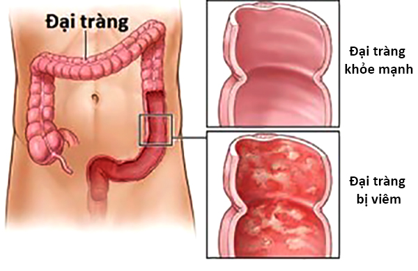 Lỵ amip không chỉ nguy hiểm ở ruột