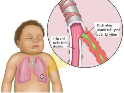  Dấu hiệu mềm sụn thanh quản ở trẻ nhỏ