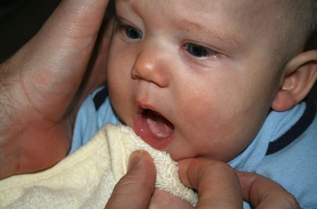 Bệnh răng miệng ở trẻ dưới 6 tháng tuổi