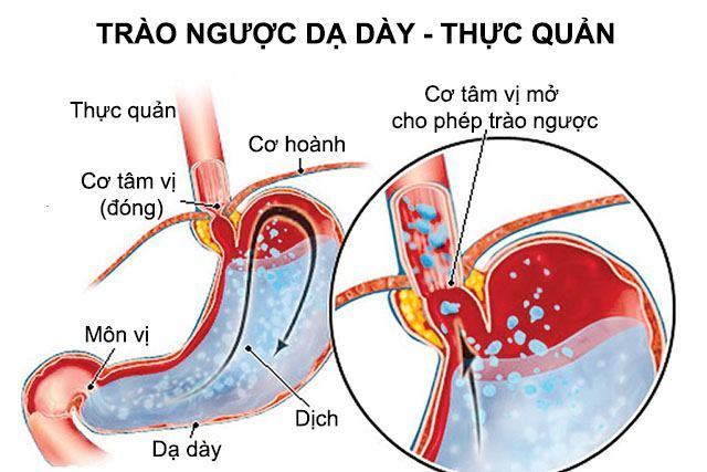 trao nguoc da day thuc quan