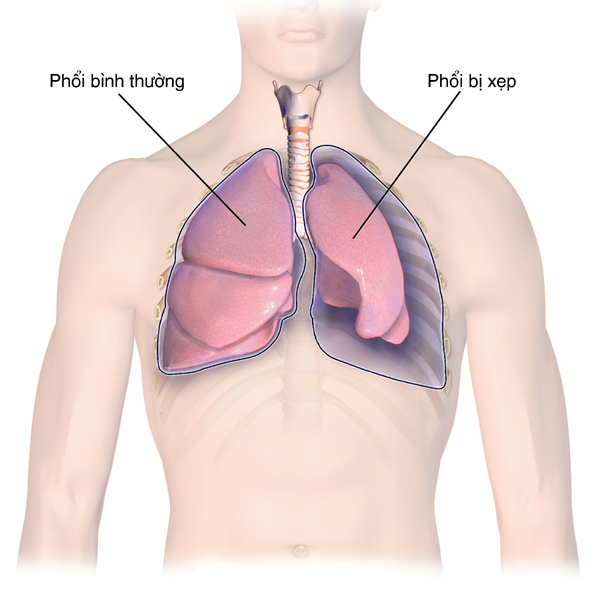 Biến chứng do tràn khí màng phổi