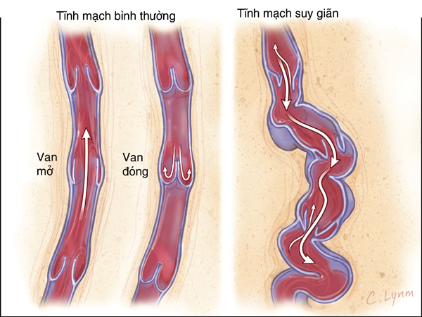 suy gian tinh mach