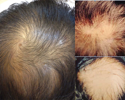 Viêm nang tóc do đâu và cách điều trị?