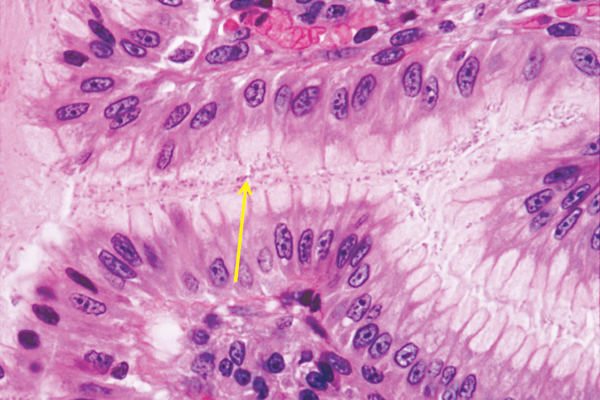 Khuẩn Helicobacter histopatholgy