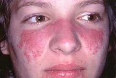 lupus ban đỏ