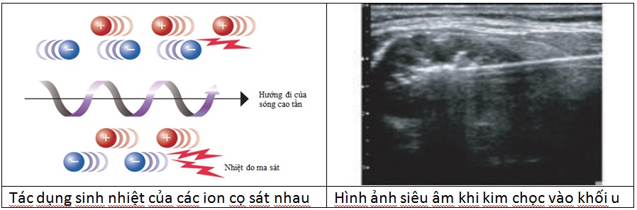 Ðốt u tuyến giáp lành tính bằng sóng cao tần