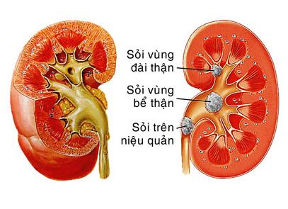 Sỏi tiết niệu làm sao tránh? Sỏi tiết niệu