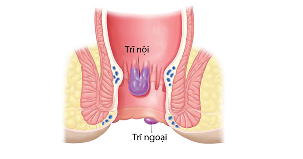 nhận biết bệnh trĩ