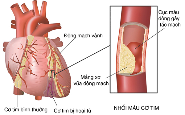 Tại sao đau ngực?