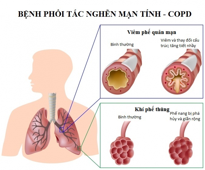 bệnh phổi tắc nghẽn mạn tính