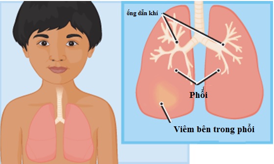 viêm phổi