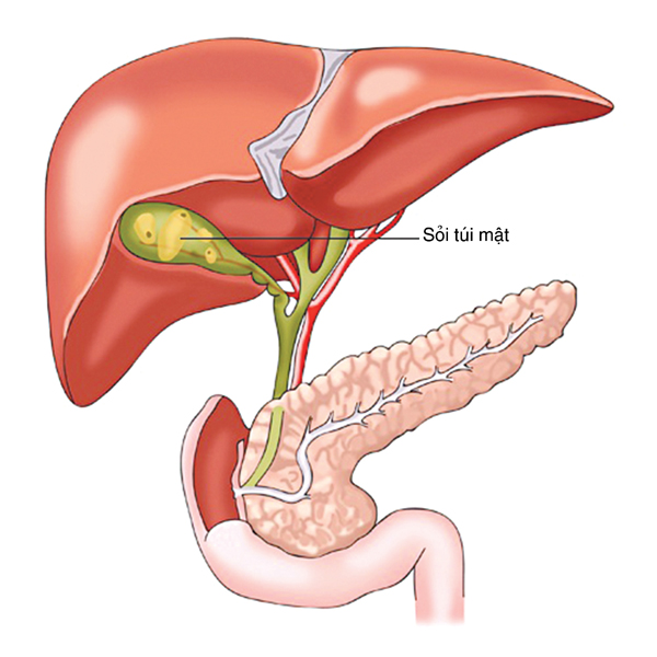 sỏi túi mật