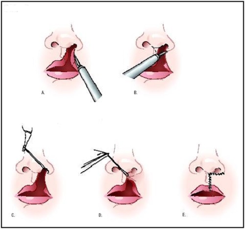 Phẫu thuật dị tật bẩm sinh khe hở môi, vòm miệng