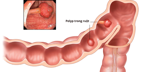 Biến chứng của bệnh polyp đại tràng