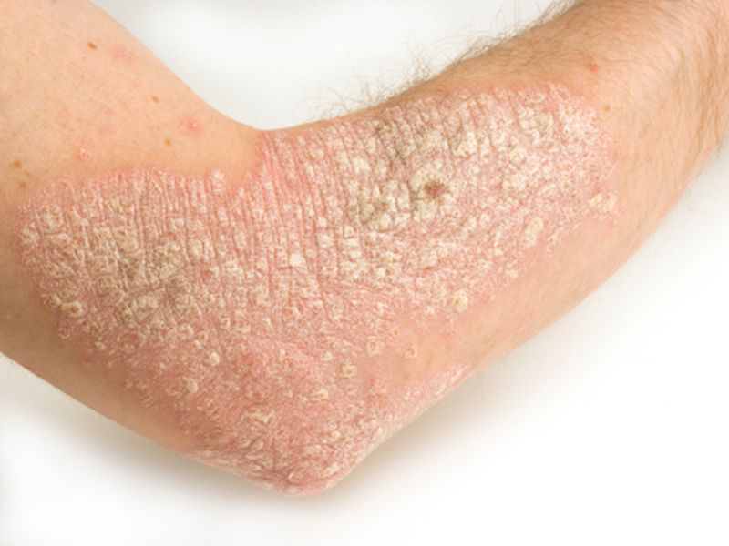 FDA phê chuẩn thuốc điều trị vảy nến dạng tiêm cho những trường hợp khó