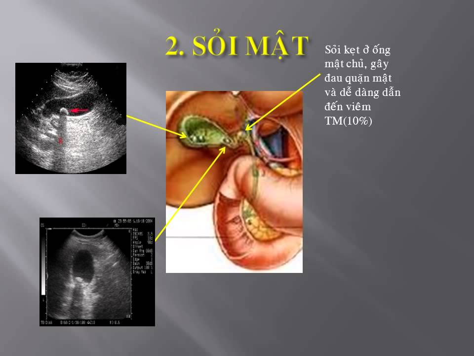 Sỏi túi mật và cách xử trí