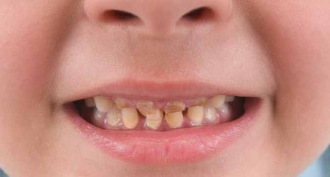 Thuốc có thể khiến răng đổi màu