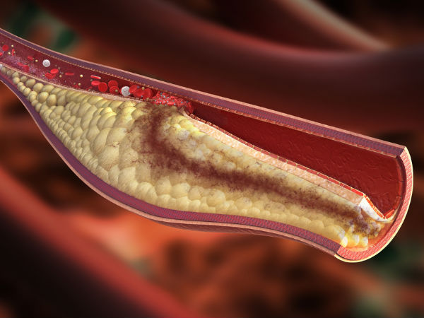 Liệu pháp đơn giản giúp giảm cholesterol