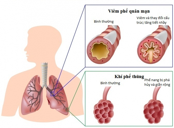 Ứng dụng tế bào gốc trong điều trị bệnh phổi tắc nghẽn mạn tính