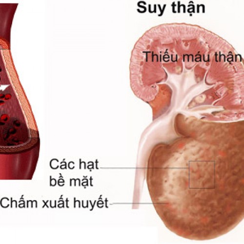Ðiều gì xảy ra nếu thận bị suy?