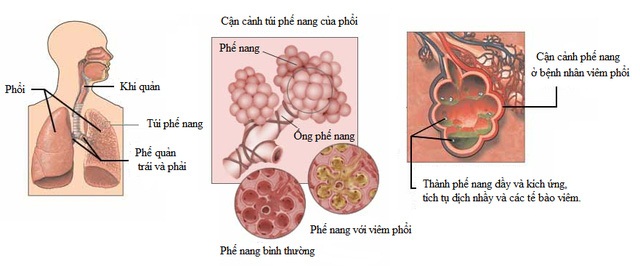  Viêm phổi ở bệnh nhân đái tháo đường