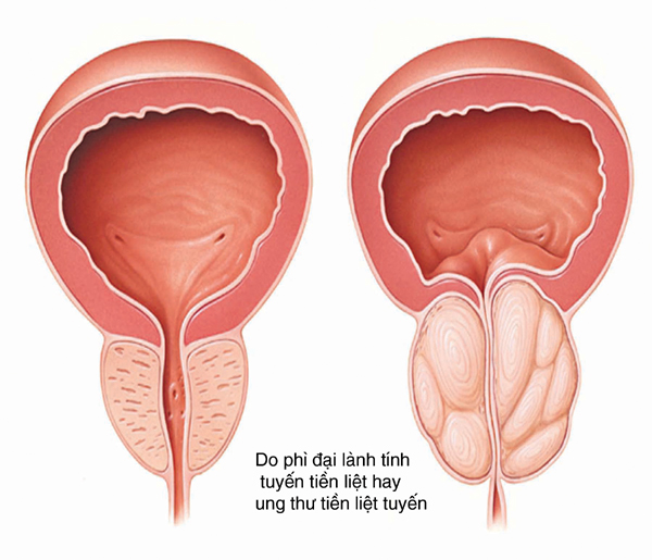 Các nguyên nhân tiểu ra máu