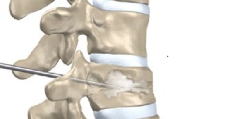 Lún xẹp đốt sống do loãng xương dễ gây tàn phế
