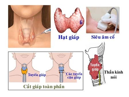 Các thể ung thư tuyến giáp