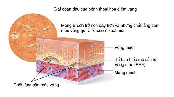 Các thuốc điều trị thoái hóa điểm vàng