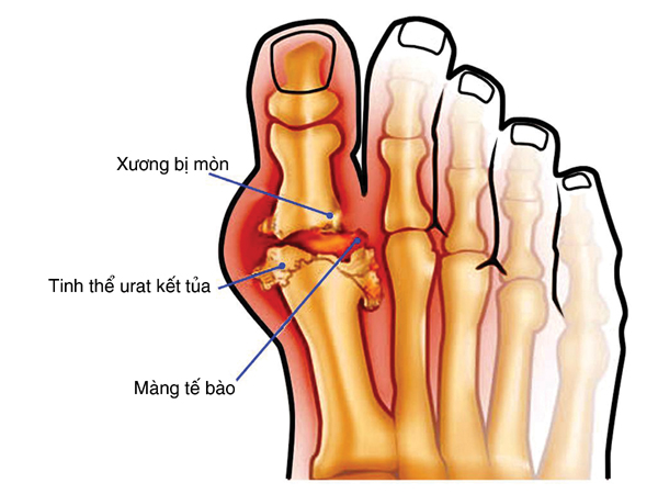 Cảnh giác cơn gút