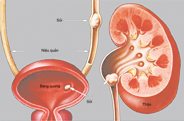 Phòng bệnh sỏi tiết niệu