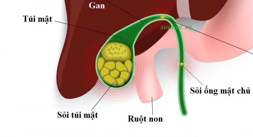 Phòng sỏi mật tái phát