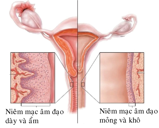 Điều trị viêm teo âm đạo