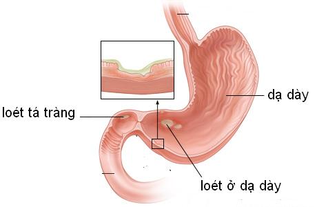 Nguyên nhân loét dạ dày - tá tràng