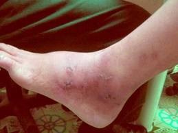 Dấu hiệu cảnh báo sớm trục trặc tim mạch