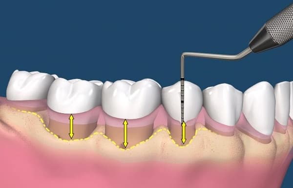 Ðối phó với chứng tụt lợi