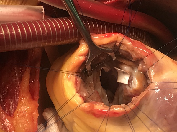 Cứu sống bệnh nhân thủng vách liên thất rất lớn do nhồi máu cơ tim hiếm gặp