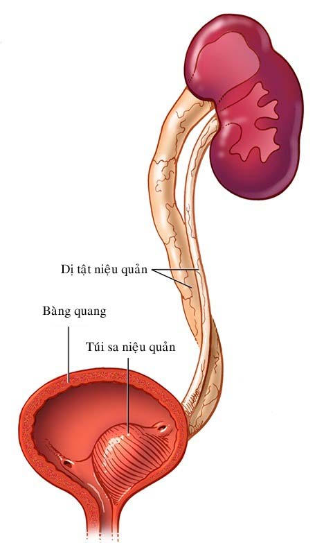 Túi sa niệu quản