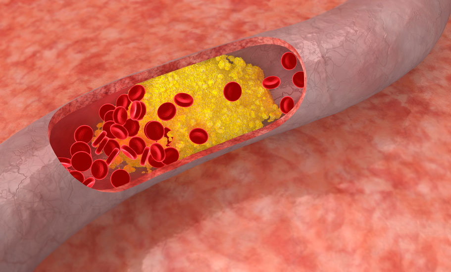 Cholesterol ảnh hưởng đến “chuyện ấy” thế nào?