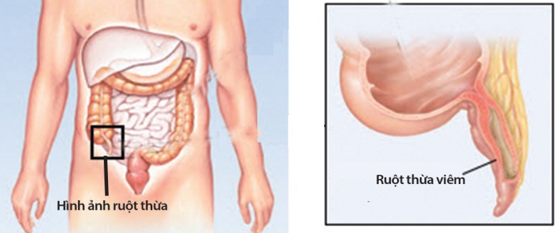 Viêm ruột thừa cấp