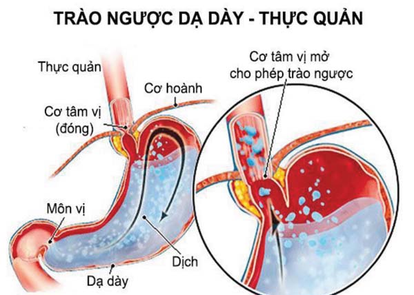 Cảnh giác với trào ngược dạ dày - thực quản