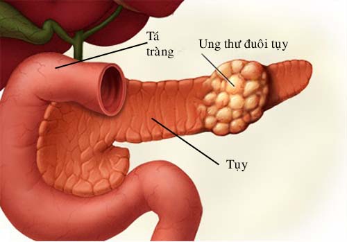 Phương pháp điều trị ung thư tuyến tụy