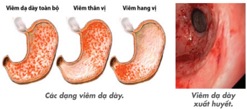 Viêm - loét dạ dày: Bệnh thường gặp ở đường tiêu hóa Viêm - loét dạ dày