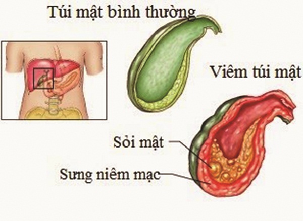 Sỏi mật có nguy hiểm?