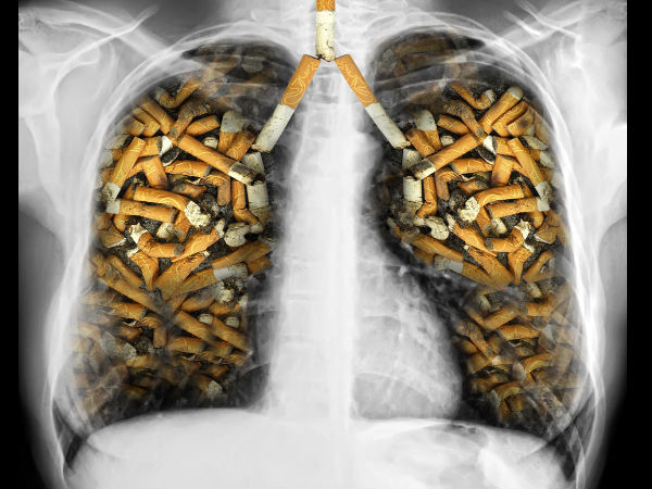 Thuốc lá - Tác nhân hàng đầu gây ung thư phổi