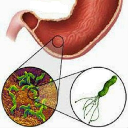 Điều trị nhiễm vi khuẩn H.pylori ở trẻ em: Còn nhiều bất cập