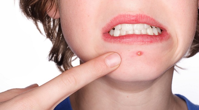 Xử trí nhọt thế nào?