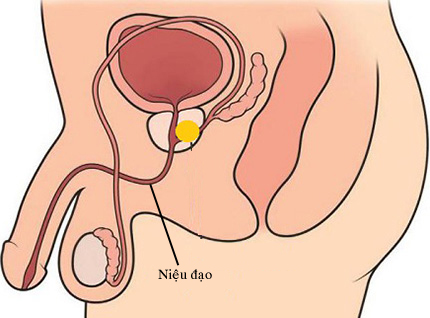 Viêm niệu đạo nam