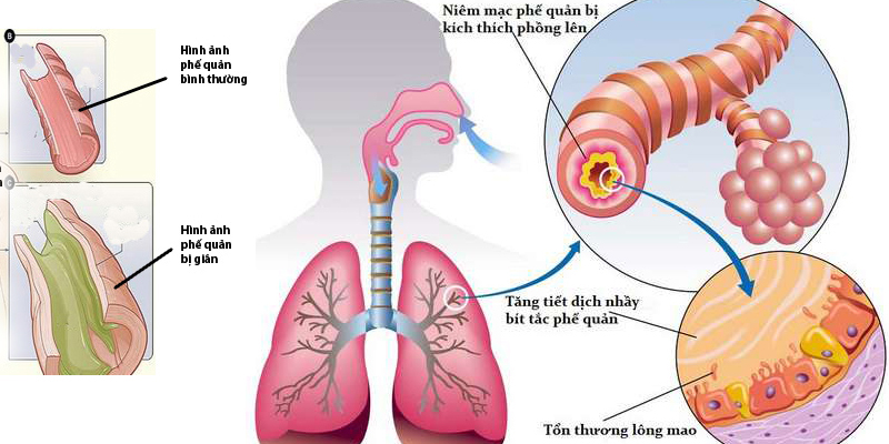 Một số nguyên nhân gây ho và cách xử lý