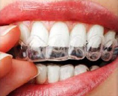 Những điều nên biết khi tẩy trắng răng